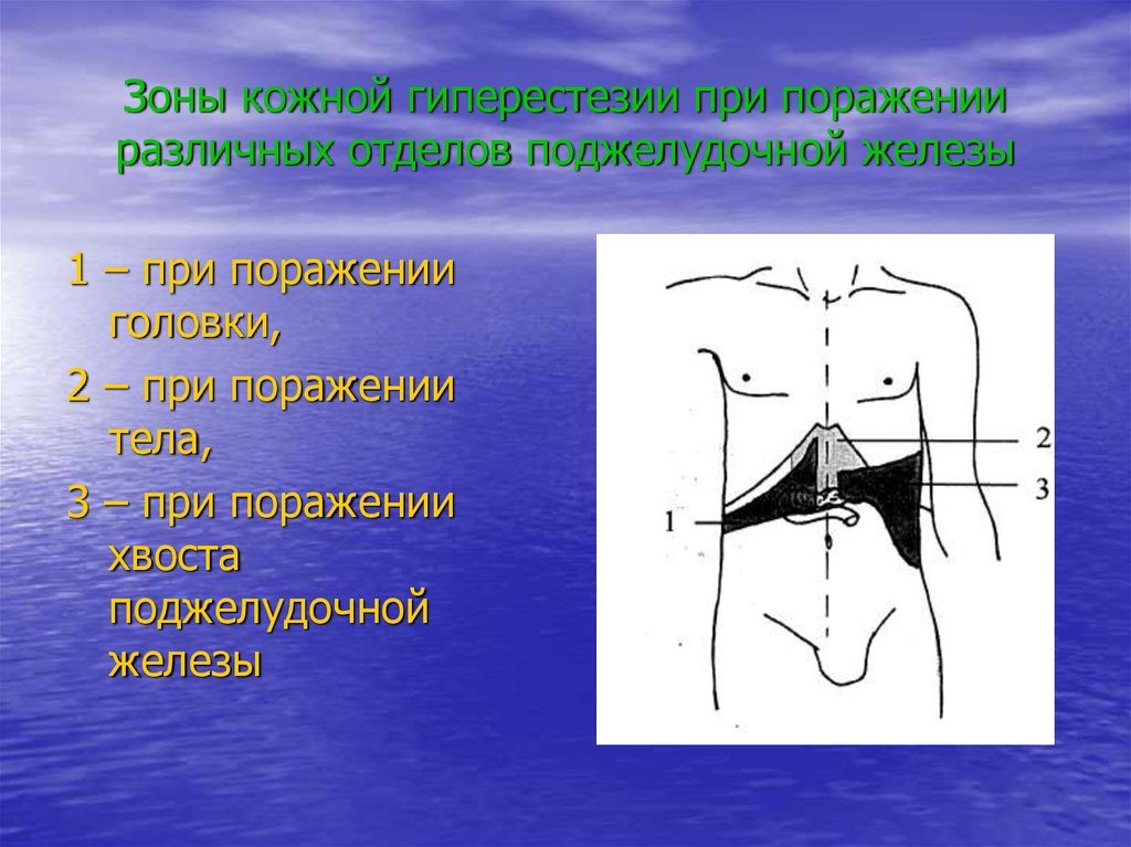 Зона кожи. Зоны кожной гиперестезии. Панкреатическая зона гиперестезии. Оценка зон кожной гиперестезии. Зоны поражения поджелудочной железы.