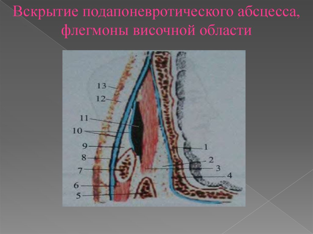 Вскрытие подапоневротической флегмоны