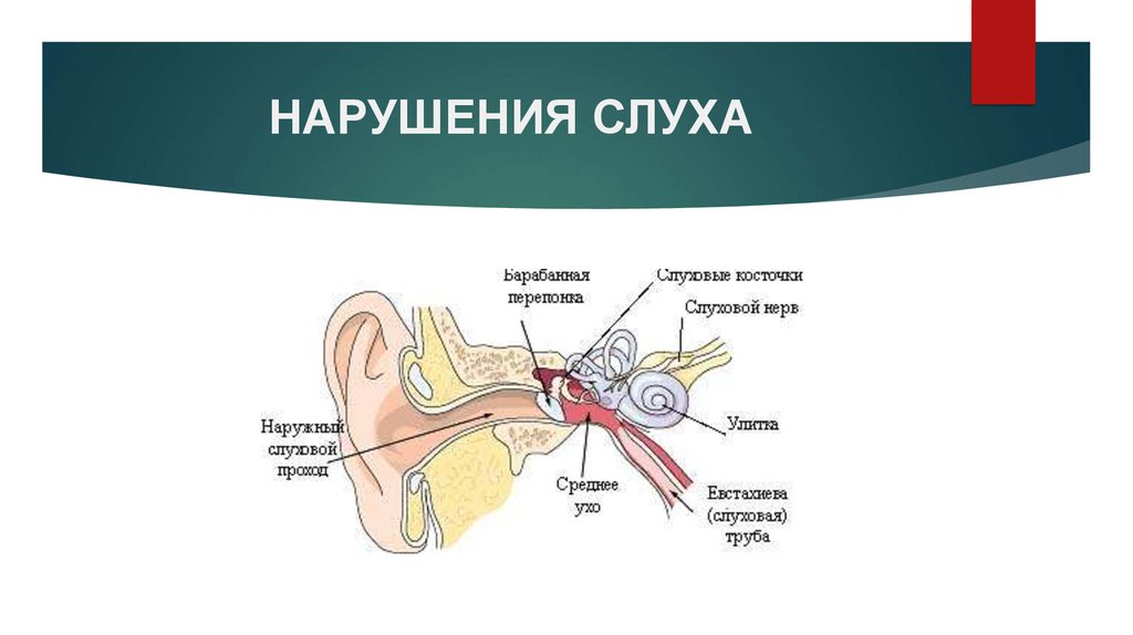 Слуховой нерв какой отдел. Кохлеарный неврит слухового нерва. Поврежден слуховой нерв. Слуховые косточки. Последствия нарушения слуха.