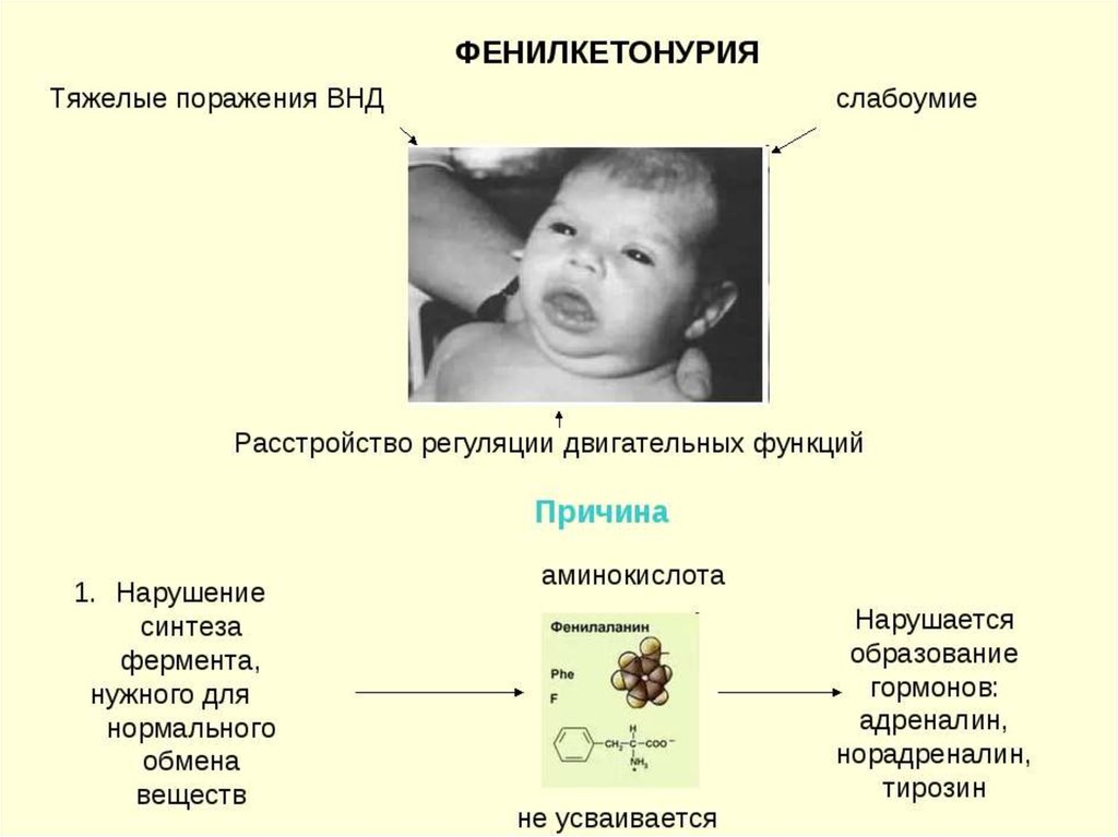 Что такое фенилкетонурия. Фенилкетонурия проявления у детей. Фенилпировиноградная олигофрения. Фенилкетонурия (фенилпировиноградная олигофрения, синдром Феллинга). Фенилкетонурия симптомы Тип наследования.