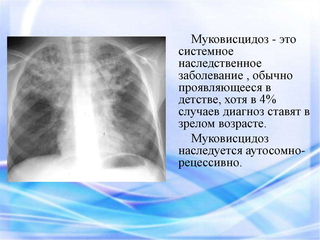 Муковисцидоз что это за болезнь. Муковисцидоз рентген признаки. Муковисцидоз бронхолегочная форма. Муковисцидоз легочная форма у детей клиника. Заболевание легких муковисцидоз.