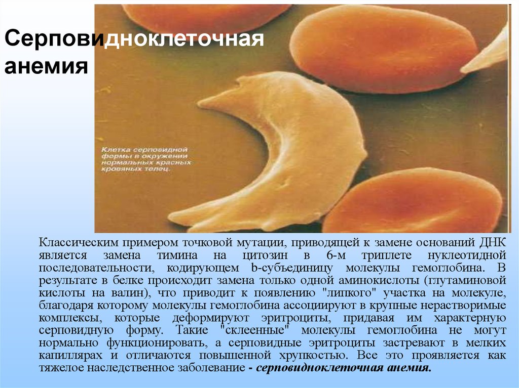 Серповидноклеточная анемия формы. Серповидноклеточная анемия. Серповидноклеточная анемия мутация.