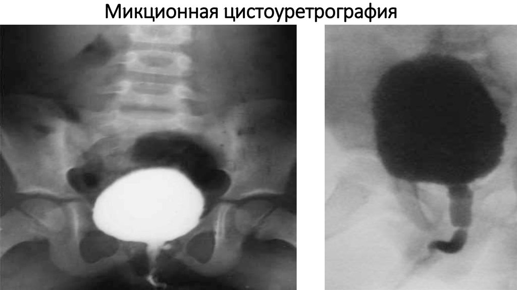 Операция шейки мочевого пузыря. Цистография мочевого пузыря рентген. Ультразвуковая микционная цистоуретроскопия. Пузырно-мочеточниковый рефлюкс микционная цистография.