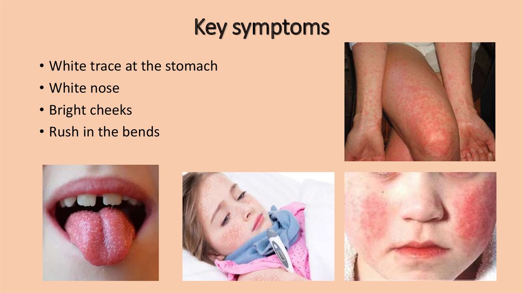 Scarlet Fever Symptoms In 6 Year Old