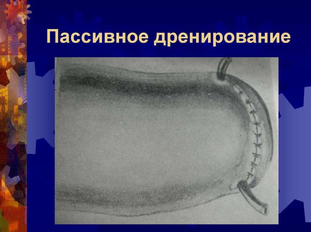 Дренирование ран презентация