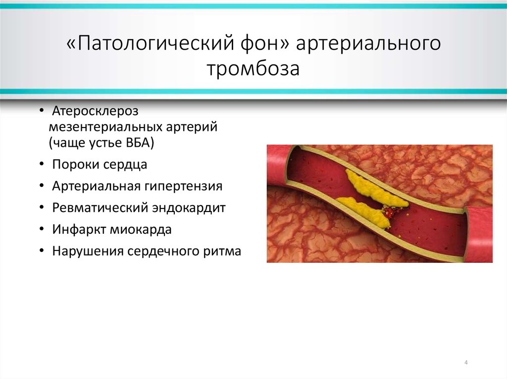 Тромбоз артерий лечение