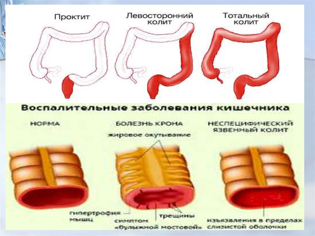 Хронический колит. Левосторонний язвенный колит. Колит кишечника у животных.