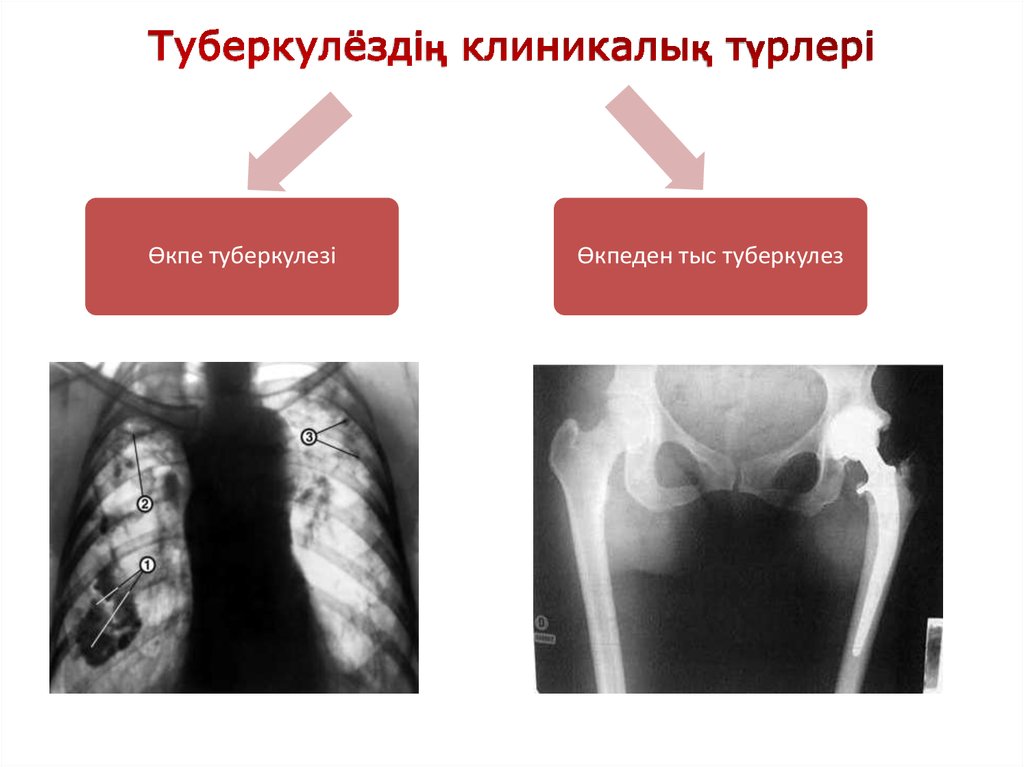 Туберкулез казакша презентация