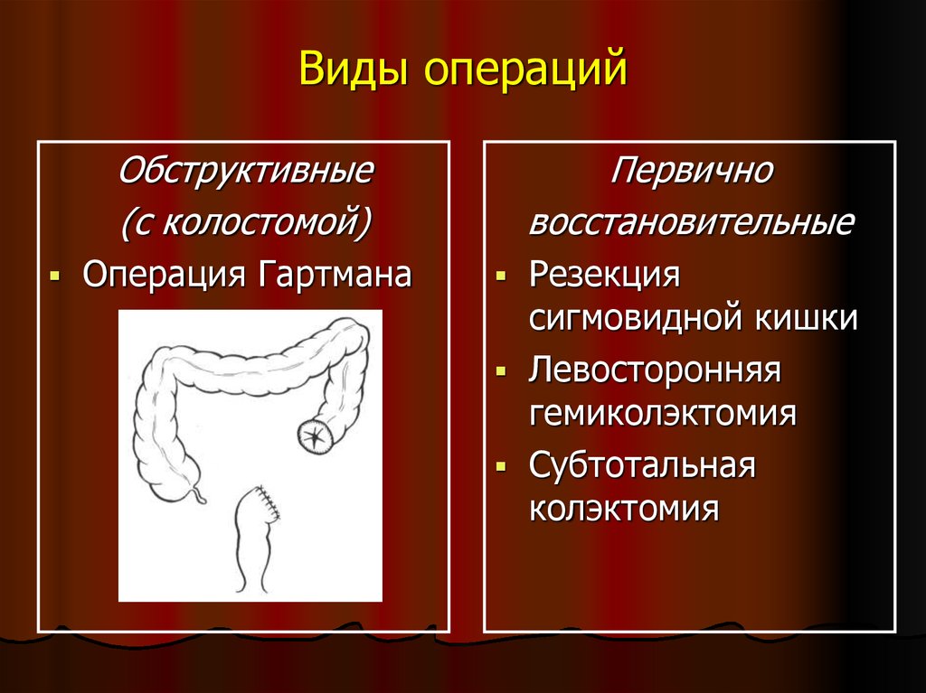 Схема операция гартмана