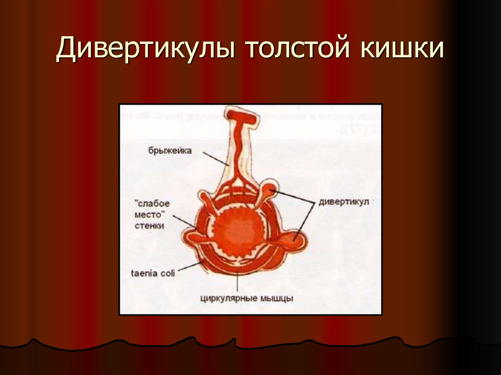 Дивертикул. Дивертикулярная болезнь патогенез. Строение дивертикула кишечника. Дивертикулез дивертикулит толстой кишки.