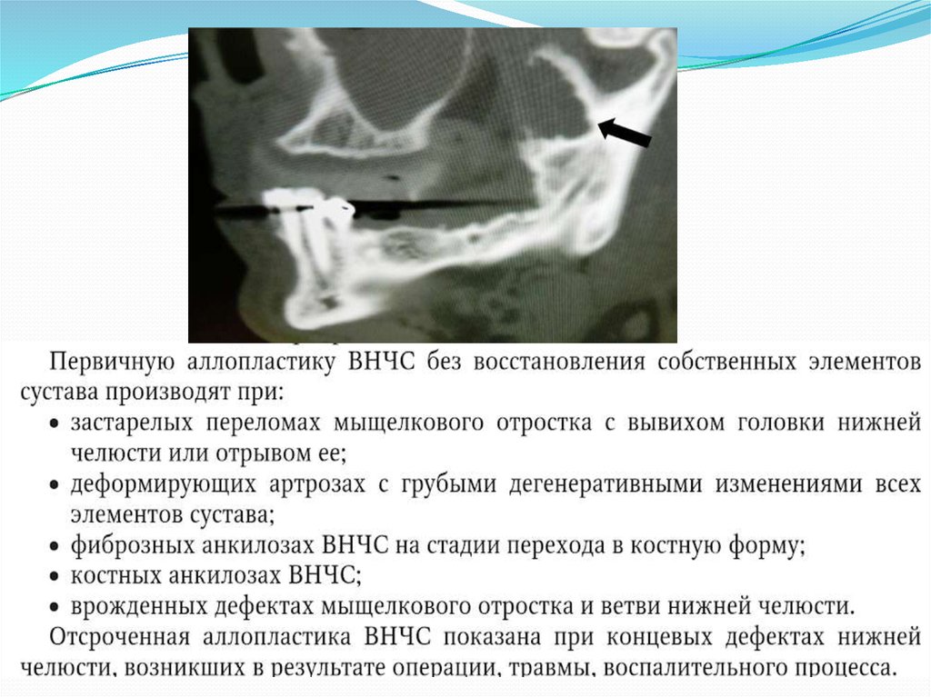 Рентгенологическая картина костного анкилоза внчс характеризуется