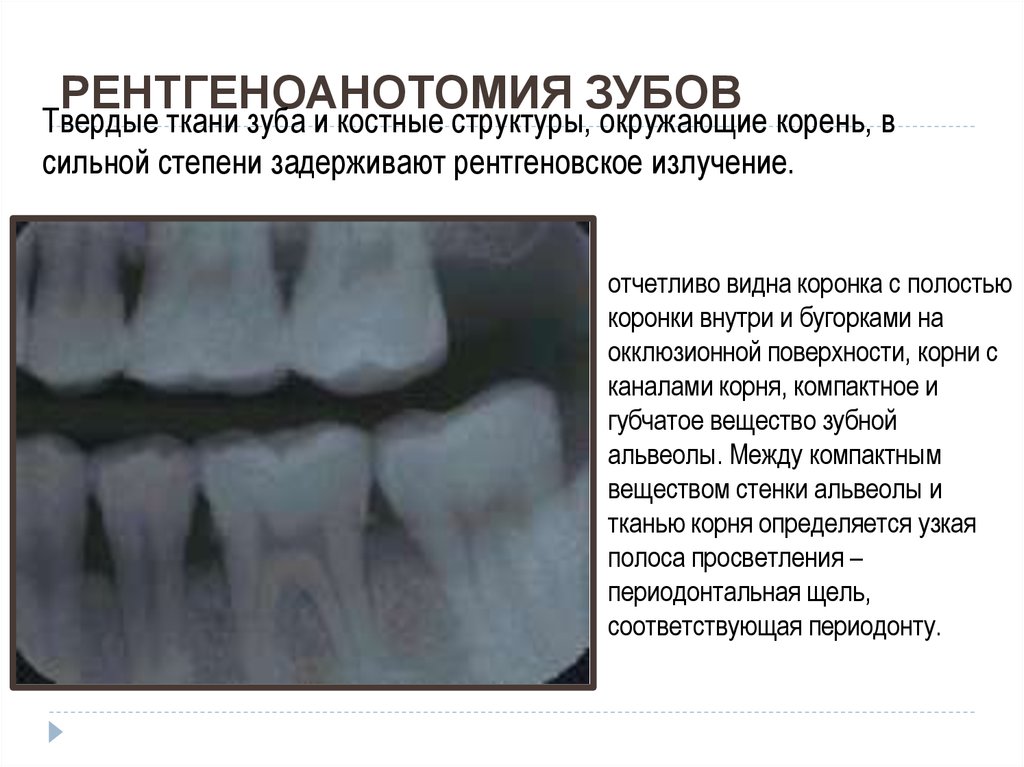 Восстановление костной ткани зубов. Расширенная Периодонтальная щель снимок. Расширение периодонтальной щели на рентгене.