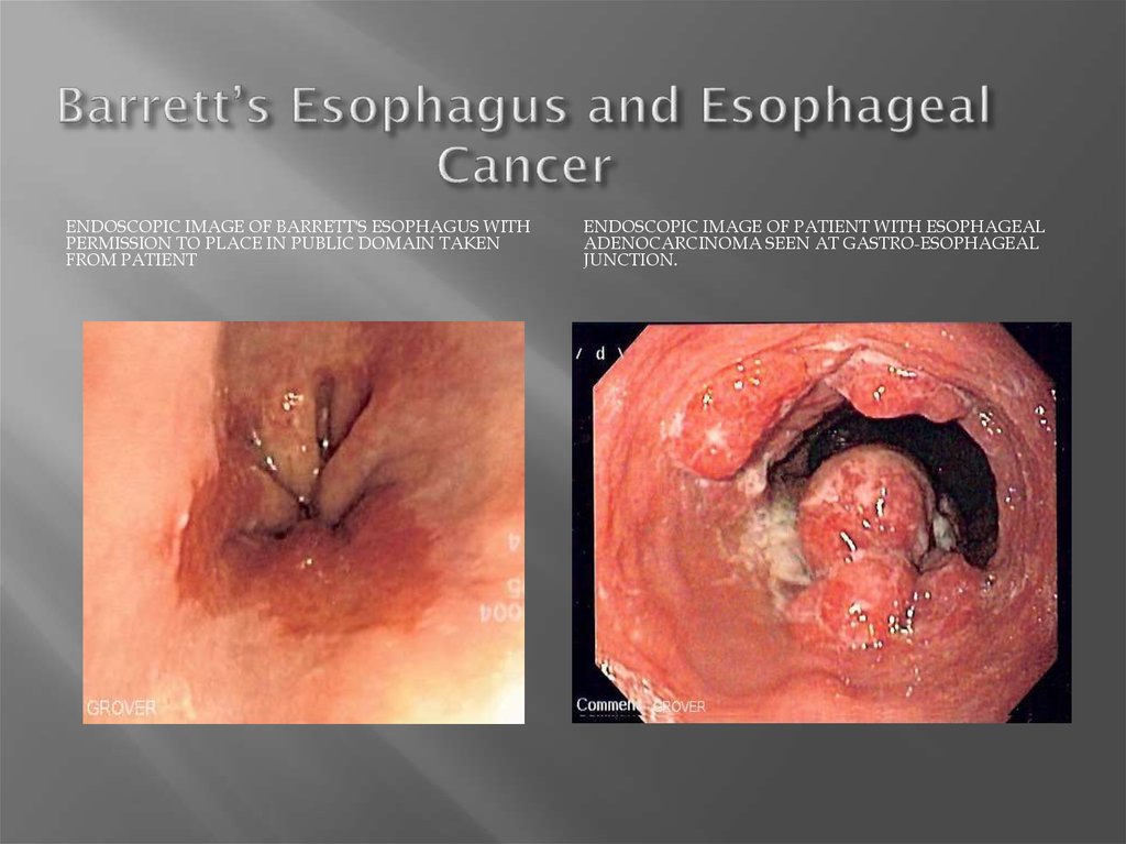 Barrett’s Esophagus and Esophageal Cancer