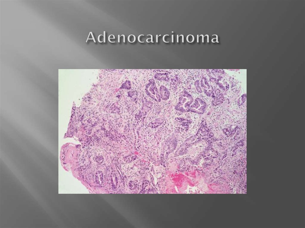 Adenocarcinoma