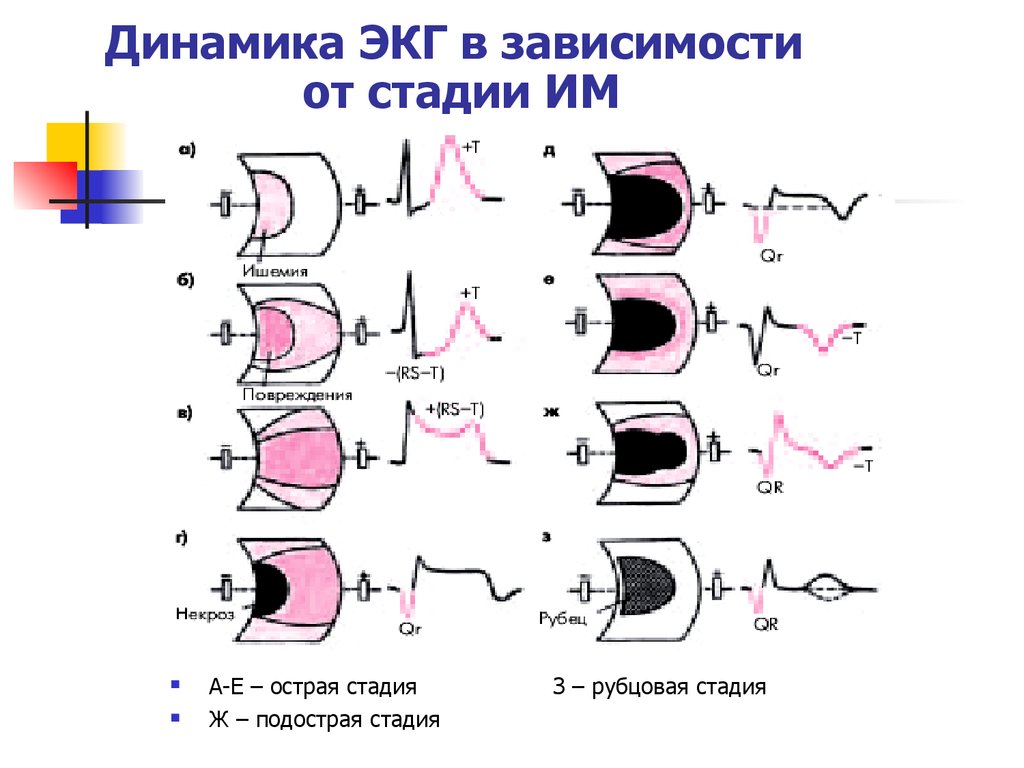 Экг степень. Стадия ишемии инфаркта миокарда на ЭКГ. ЭКГ инфаркт миокарда пропедевтика. Динамика инфаркта ЭКГ. Стадии ишемии на ЭКГ.