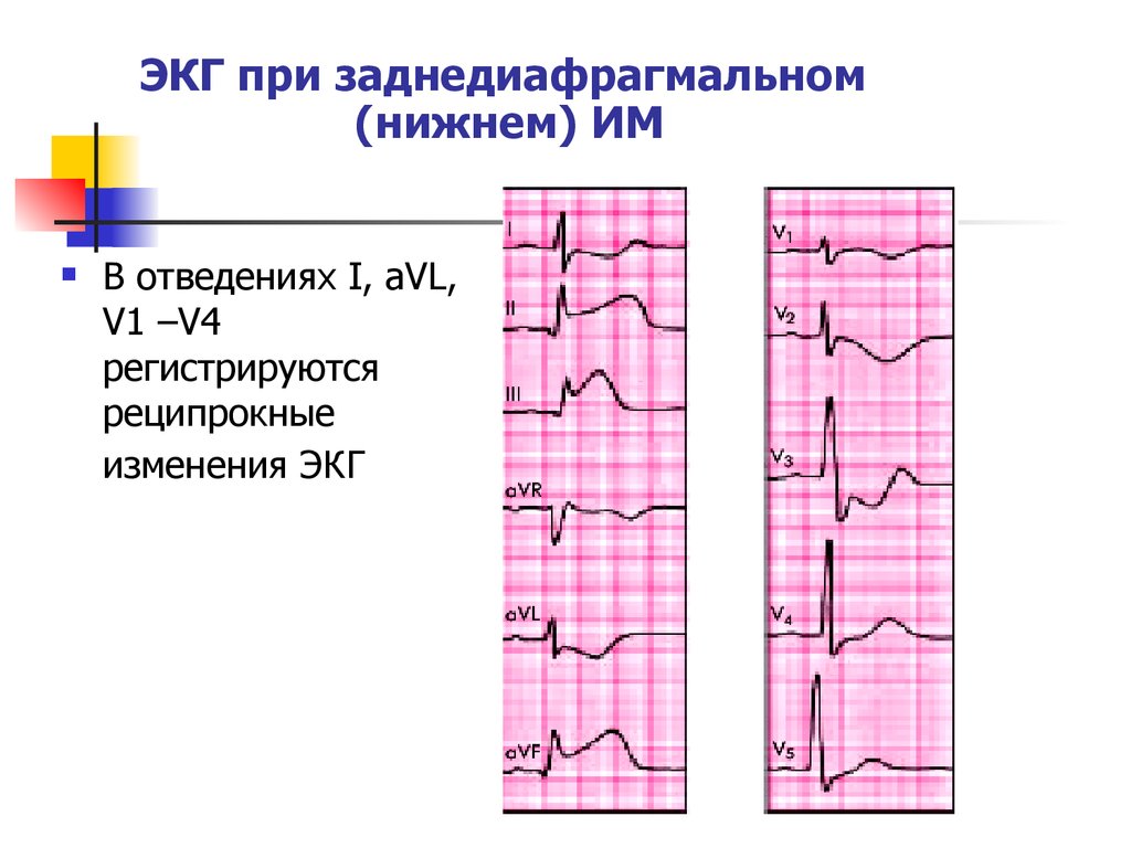 Отведение v1 на экг. Инфаркт миокарда ЭКГ реципрокные изменения. Отведения ЭКГ инфаркт. Реципрокные отведения на ЭКГ. Реципрокные признаки ЭКГ.