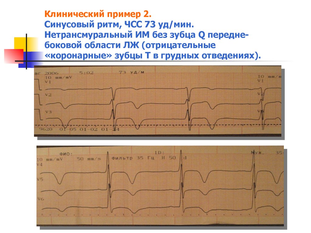 Экг отрицательный. Отрицательный т на ЭКГ В грудных отведениях. Отрицательный зубец т на ЭКГ В грудных. Отрицательный т на ЭКГ во всех отведениях. Отрицательный зубец т в отведении v2.