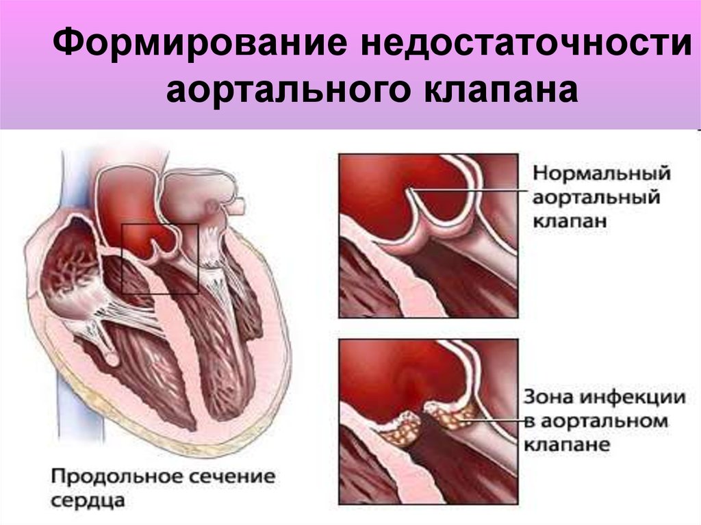 Поражение митрального клапана. Недостаточность аортального клапана сердце. Порок аортального клапана патанатомия. Аортальная недостаточность порок сердца. Недостаточность митрального клапана и аортального клапана.