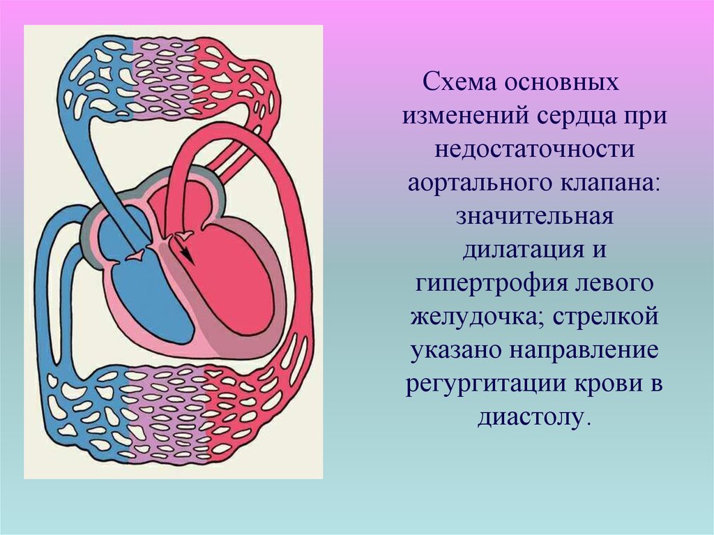 Дилатация левого желудочка что это. Дилатация левого предсердия. Дилатация сердца схема. Гипертрофия и дилатация сердца. Тоногенная и миогенная дилатация сердца.