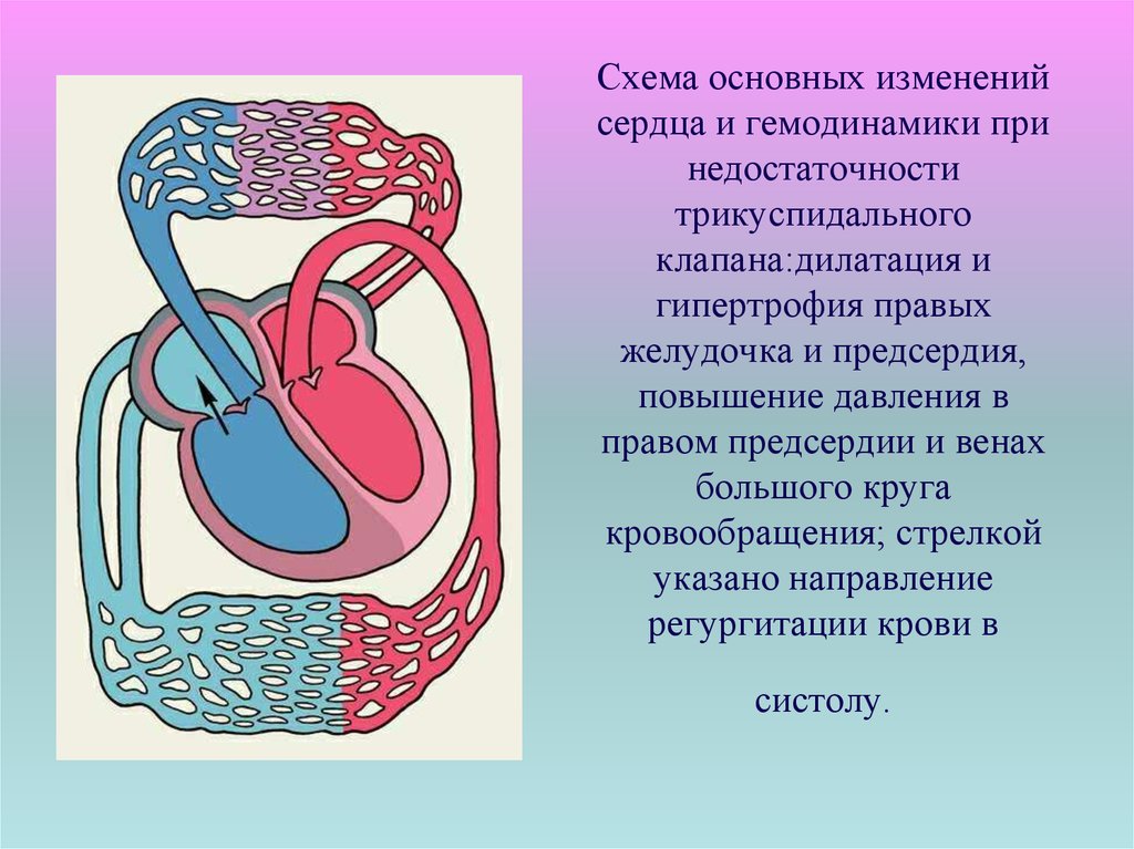 Недостаточность трикуспидального клапана презентация