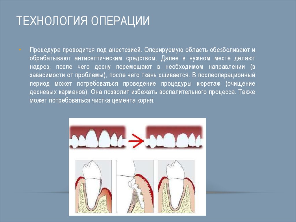 Общие принципы пародонтальной хирургии презентация