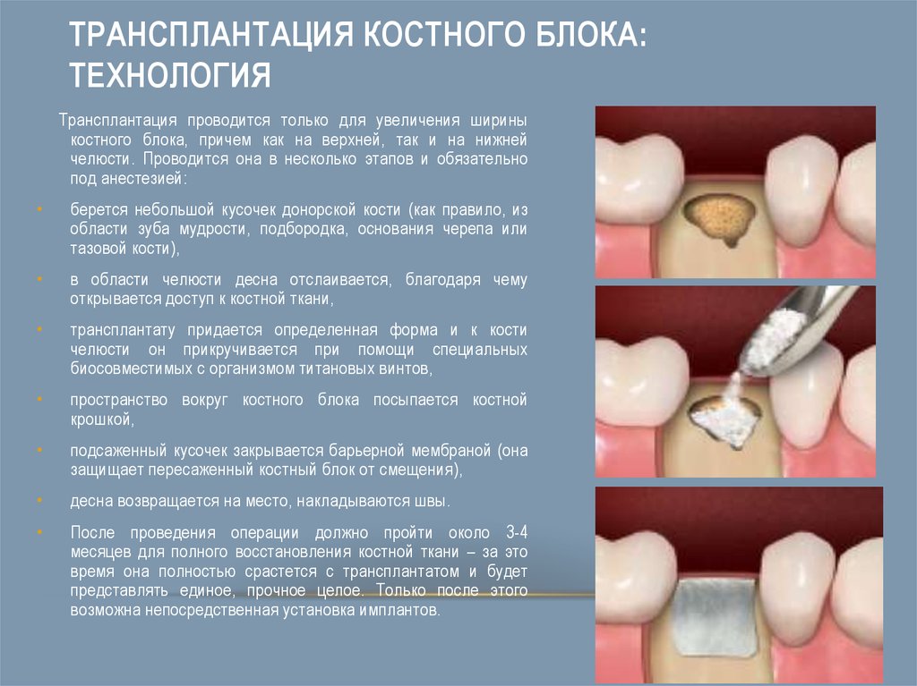 Костная пластика презентация