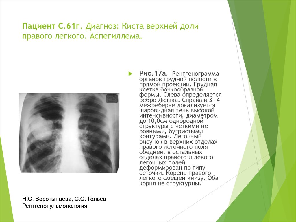 Тени в верхней доле легкого. Киста верхней доли правого легкого. Образование в верхней доле правого легкого. Образование верхней доли правого легкого. А 17 диагноз.