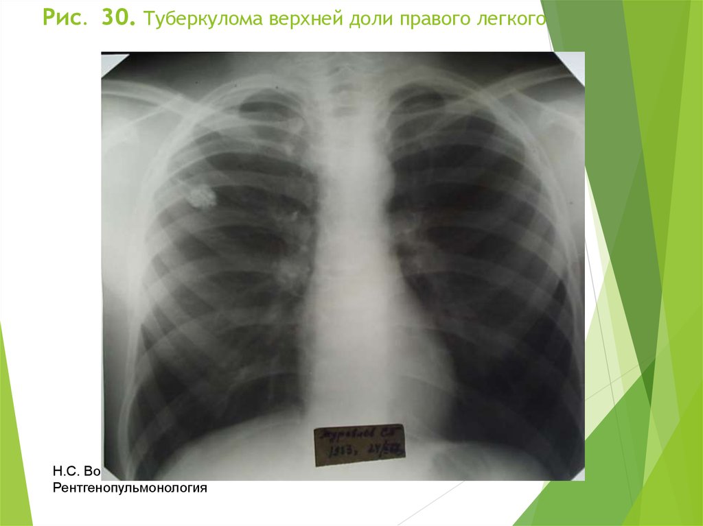 Округлыми формами в легком. Туберкулема фтизиатрия. Туберкулома легких снимок. Туберкулома лёгкого рентген. Туберкулема легкого рентген.