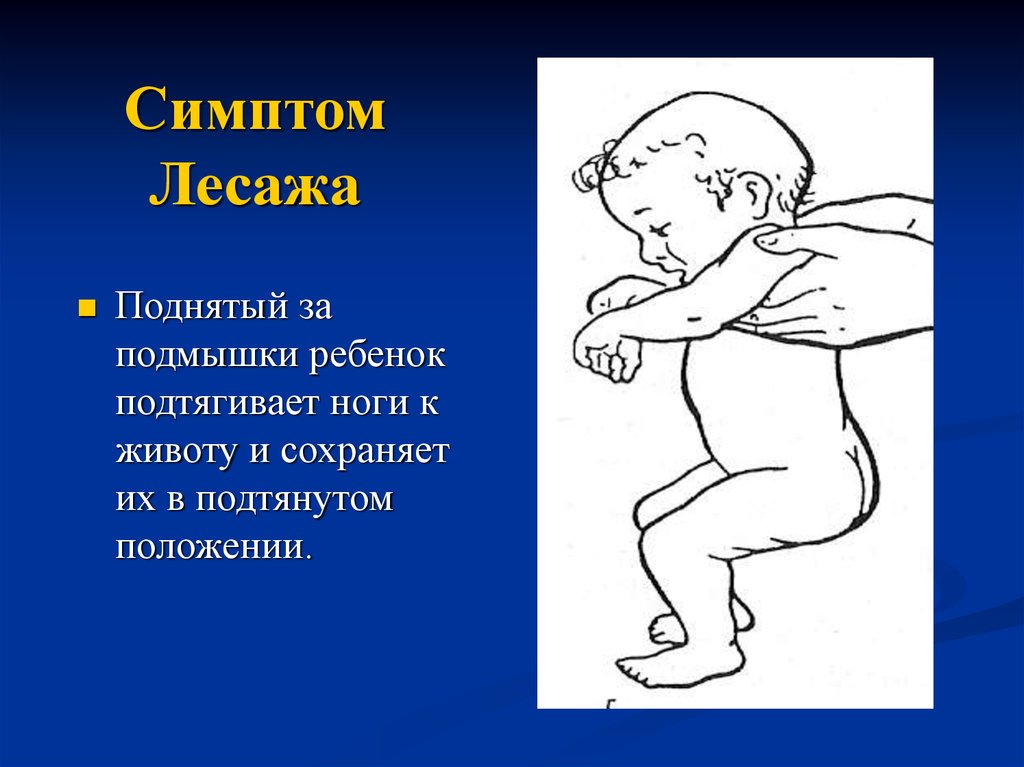 Симптом года. Симптом Лесажа менингеальный. Симптом подвешивания Лесажа. Стиптом подаешиаания Лессада.