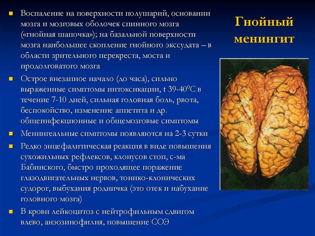 Воспаление головного мозга. Гнойный менингит патоморфология. Первичный Гнойный менингит вызывается. Острый Гнойный менингит. Гнойный менингит макропрепарат.