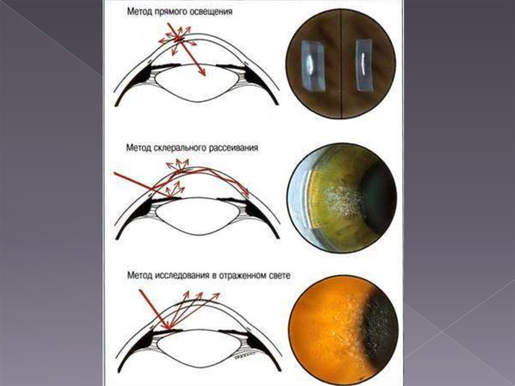 Боковое фокальное освещение. Биомикроскопия глаза метод. Биомикроскопия это метод. Биомикроскопия методика. Исследование биомикроскопия сред глаза.