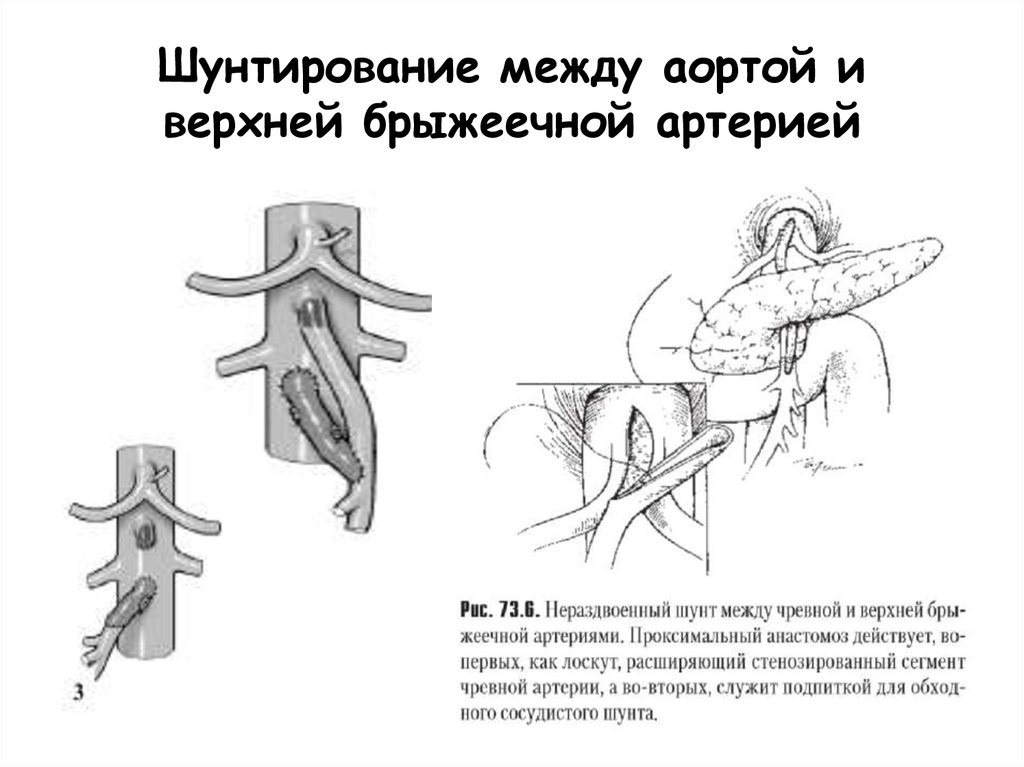 Сонно подключичное шунтирование схема операции