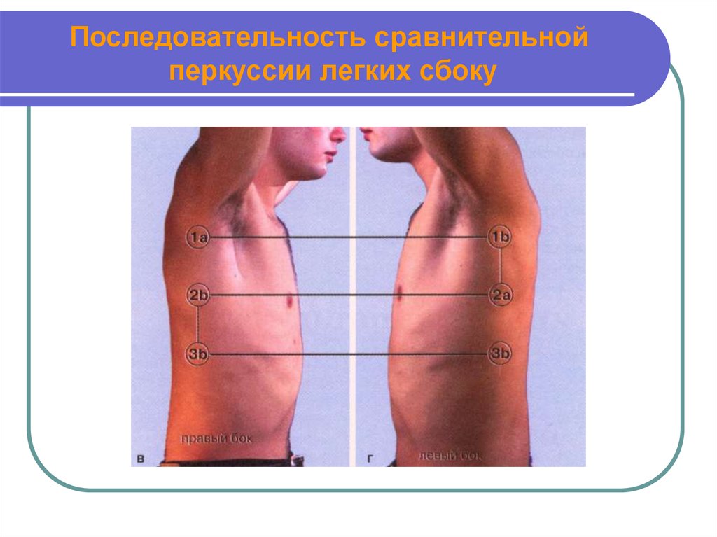 Сравнительная перкуссия. Сравнительная перкуссия легких пропедевтика. Сравнительная перкуссия легких сбоку. Перкуссия по передней поверхности грудной клетки. Точки перкуссии легких сбоку.