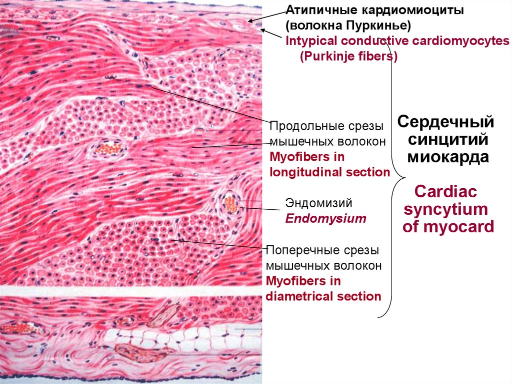 Атипичные кардиомиоциты рисунок