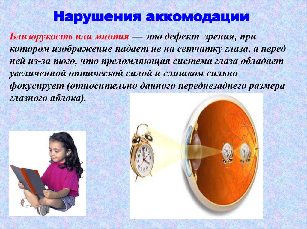 Миопия что это такое у детей. Нарушения аккомодации зрительного анализатора.. Миопия и спазм аккомодации. Нарушение зрения миопия. Аккомодационные нарушения зрения.
