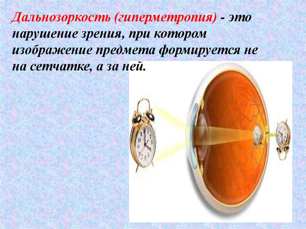 Изображение предмета формируется. Дальнозоркость. Дальнозоркость (гиперметропия). Дальнозоркость картинки. На сетчатке формируется изображение.