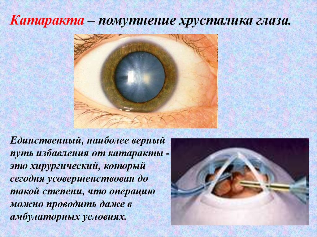 Операция катаракта замена хрусталика отзывы. Катаракта схема глаза. Катаракта хрусталик строение. Катаракта презентация. Спицевидная катаракта.