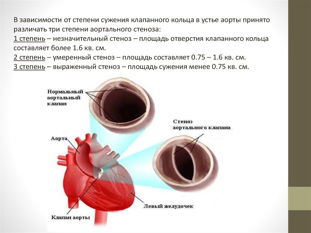 Аортальный стеноз что это такое. Степень раскрытия аортального клапана. Стеноз аортального клапана степени. Классификация аортального клапана. Аортальный стеноз 2 степени.