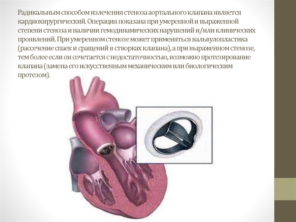 Аортальный стеноз что это такое. Операции при стенозе аортального клапана. Стеноз двустворчатого аортального клапана. Аортальный стеноз (сужение отверстия аорты);. Операция стеноз аортального клапана.