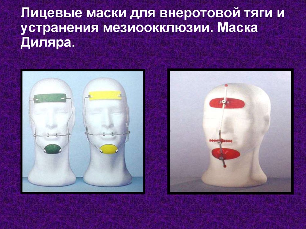 Лицевая маска. Маска Диляра для внеротовой тяги. Лицевая маска Диляра ортодонтия. Аппарат Диляра, лицевая маска. Внеротовая лицевая маска.