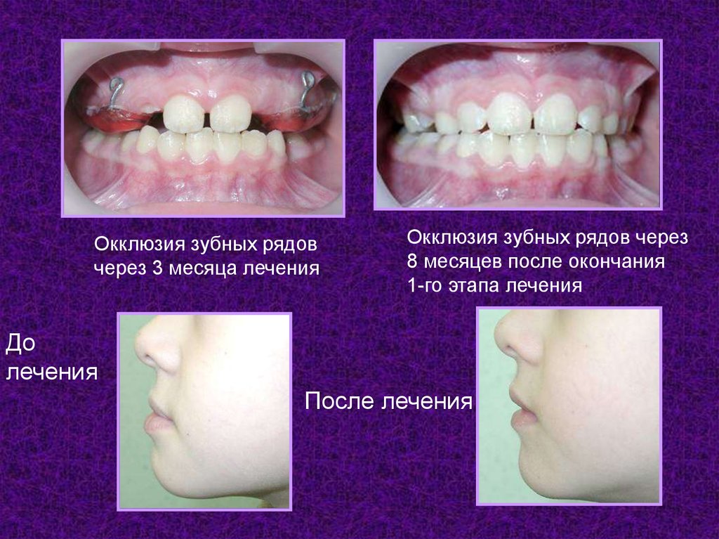 Этиология классификация клиническая картина диагностика и лечение различных форм дистальной окклюзии