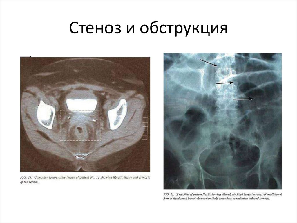 Осложнения лучевой терапии презентация