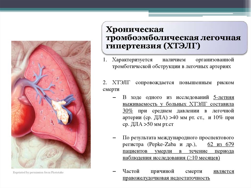 Заболевание тромбоэмболия легочной артерии