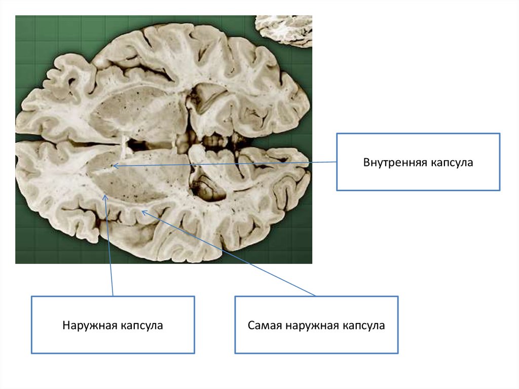 Внутренняя капсула. Внутренняя капсула конечного мозга. Самая наружная капсула конечный мозг. Базальные ядра наружная капсула. Базальные ганглии анатомия наружная капсула.