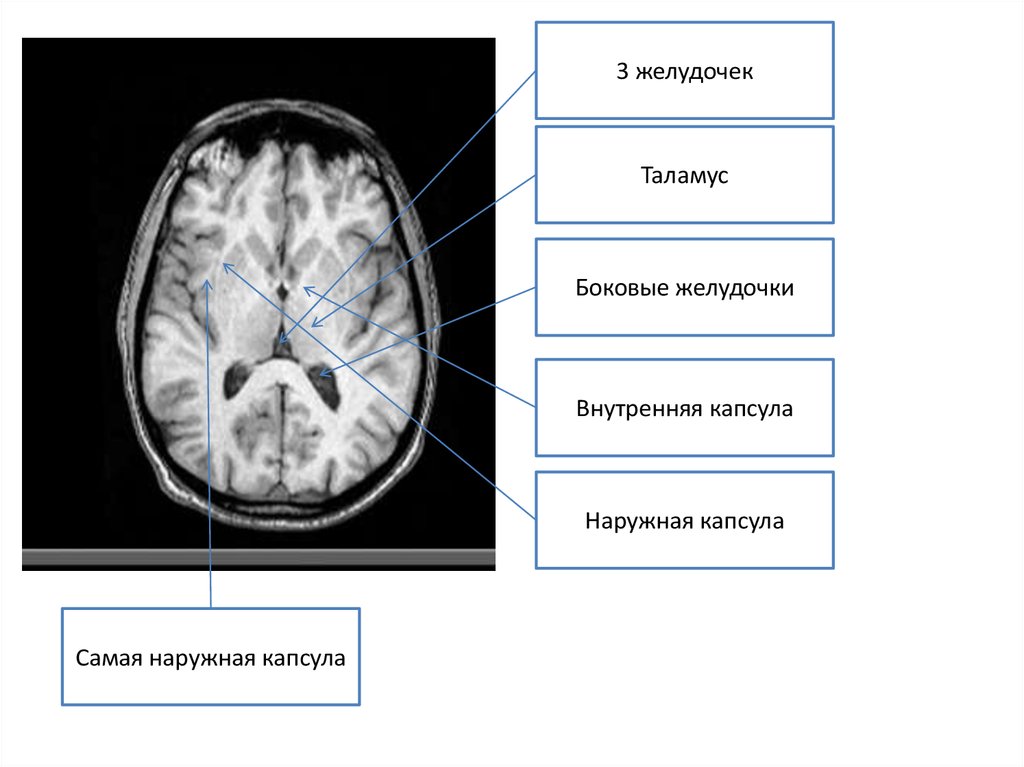 Асимметрия боковых желудочков головного мозга. Таламус мрт.