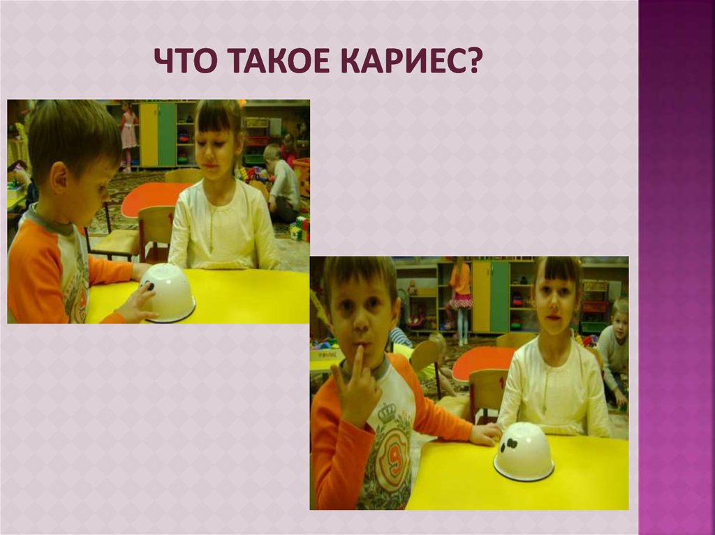 Что такое кариес?