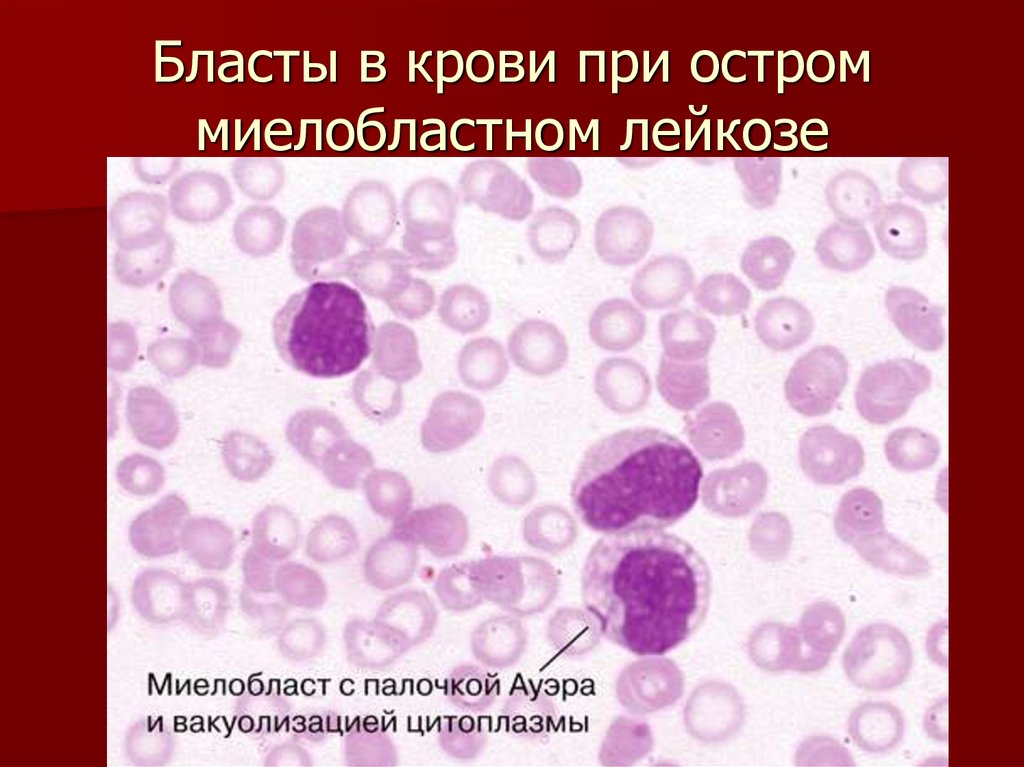 Бласты в крови при остром миелобластном лейкозе