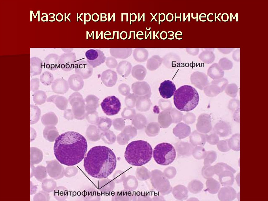 Картина крови при хроническом миелолейкозе