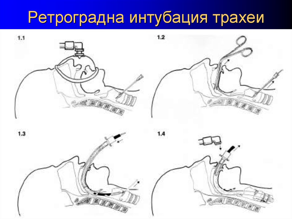 Интубация трахеи. Набор для ретроградной интубации трахеи. Методика ретроградной интубации трахеи. Техника проведения интубации трахеи алгоритм.