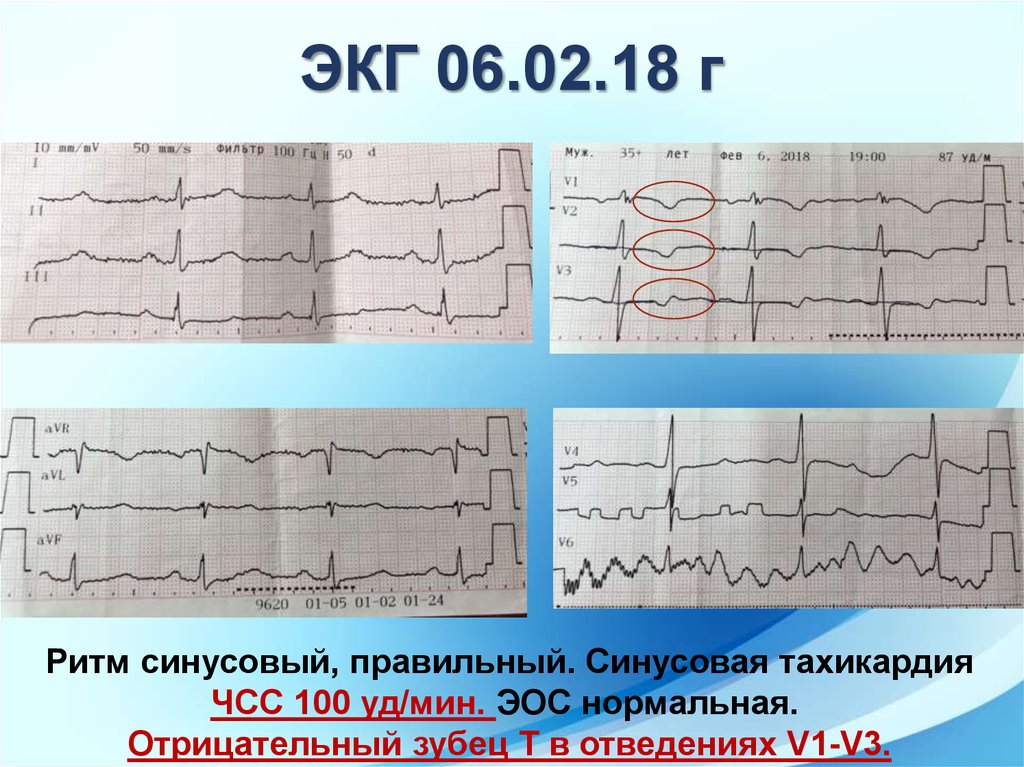 Экг 6. ЭКГ зубец t отрицательный в v1. Отрицательный зубец т на ЭКГ В 1 отведении. Отрицательный т в отведении v1. Отрицательный зубец t в v1 и v2.